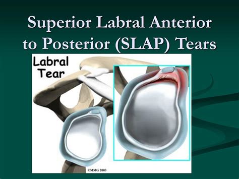 superior labral tear